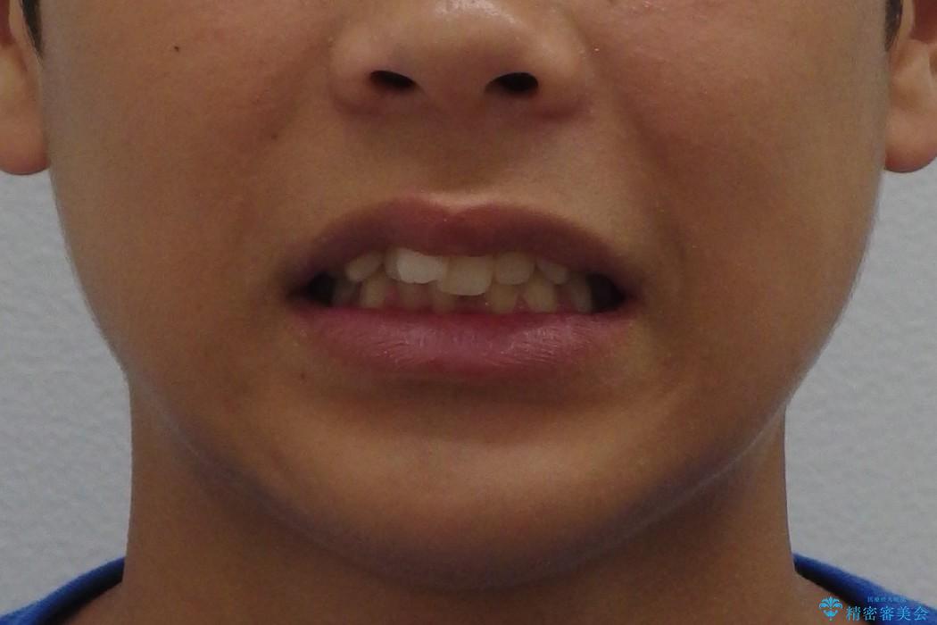 10代男性　出っ歯　歯を抜かない矯正の治療前（顔貌）