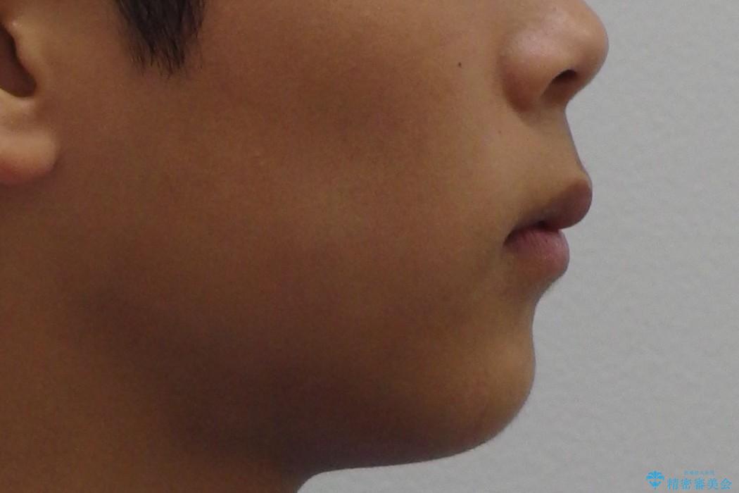 10代男性　出っ歯　歯を抜かない矯正の治療前（顔貌）