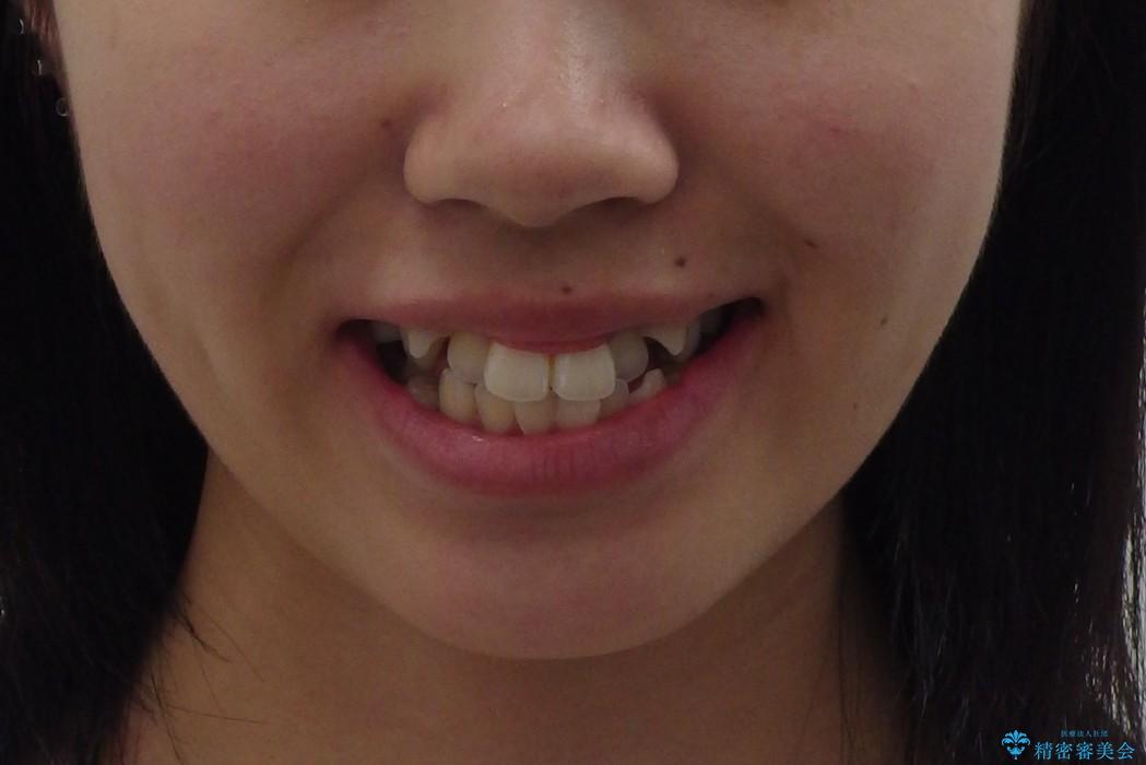 八重歯　神経のない奥の歯を抜歯の治療前（顔貌）
