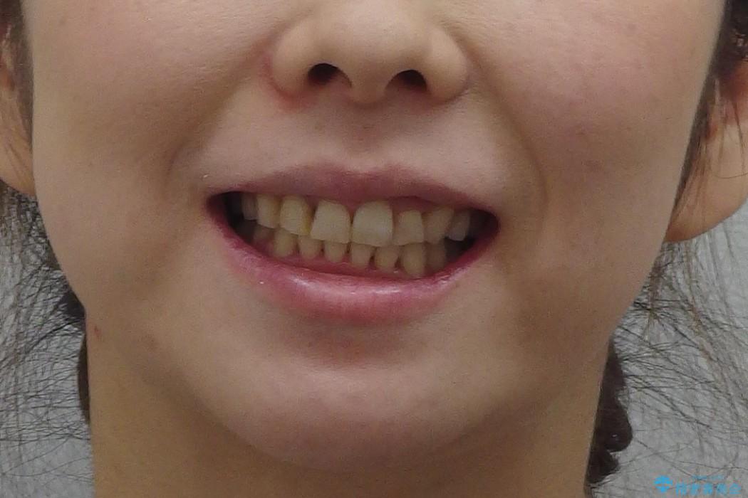 30代女性　前歯の著しいがたがた　親知らずを活用の治療後（顔貌）