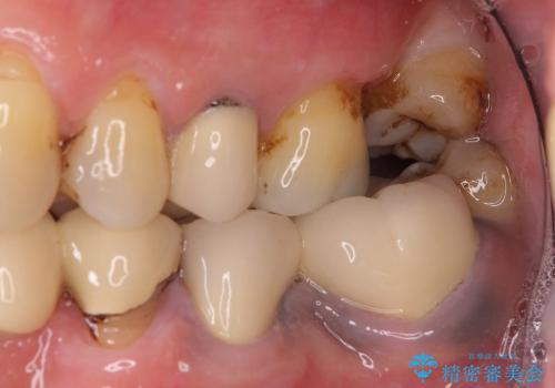 歯の根元が露出してきた　オールセラミックの再補綴での改善の治療前
