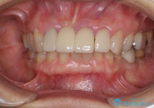前歯のブリッジがすぐに外れる　まずは土台の歯をしっかりと改善の治療前