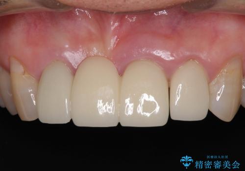 前歯のブリッジがすぐに外れる　まずは土台の歯をしっかりと改善の治療前
