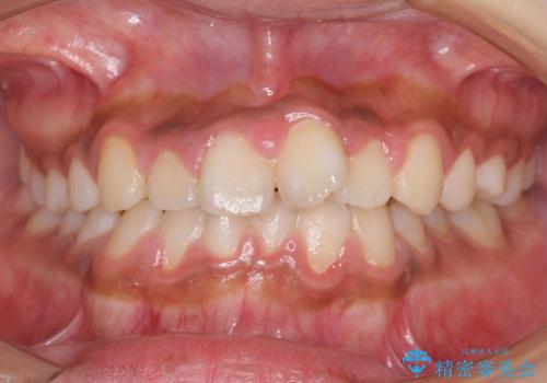 [大きい正中のずれ] 裏側矯正で前歯のねじれ・顎のゆがみを改善の治療前