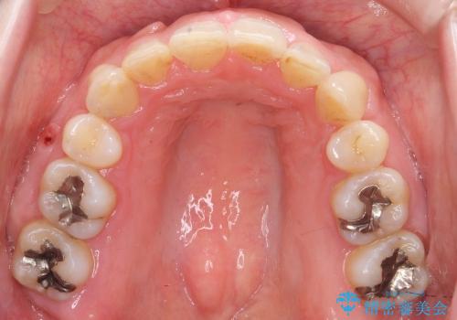 30代女性　前歯の著しいがたがた　親知らずを活用の治療後