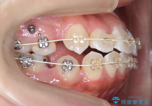 八重歯　神経のない奥の歯を抜歯の治療中