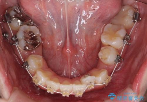 八重歯　神経のない奥の歯を抜歯の治療中