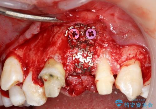 30代女性　ミゼラブルな前歯の陥没を再生する①1次手術による骨造成の治療中