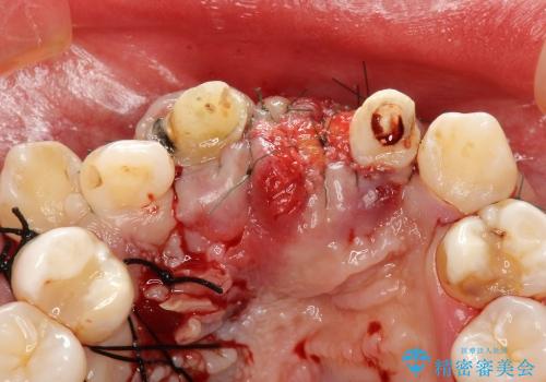 30代女性　ミゼラブルな前歯の陥没を再生する①1次手術による骨造成の治療中