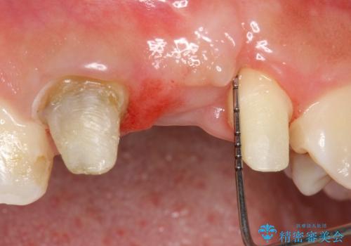 30代女性　ミゼラブルな前歯の陥没を再生する③完成への治療中