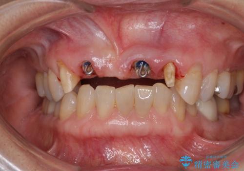 前歯のブリッジがすぐに外れる　まずは土台の歯をしっかりと改善の治療中