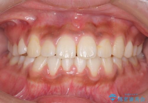 [大きい正中のずれ] 裏側矯正で前歯のねじれ・顎のゆがみを改善の治療後