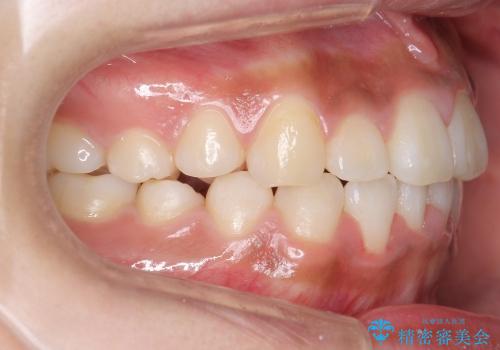 [大きい正中のずれ] 裏側矯正で前歯のねじれ・顎のゆがみを改善の治療後