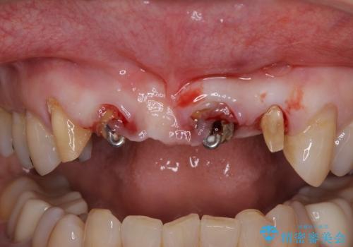 前歯のブリッジがすぐに外れる　まずは土台の歯をしっかりと改善の治療中