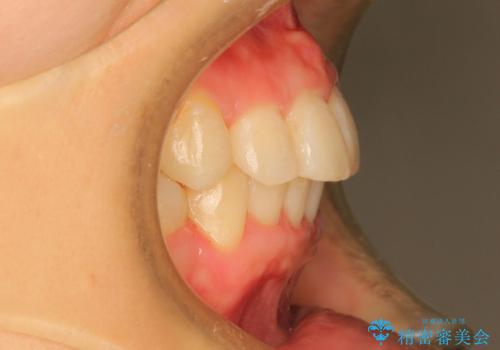20代女性　ガタガタの歯を矯正してきれいに　表のワイヤー矯正の治療後