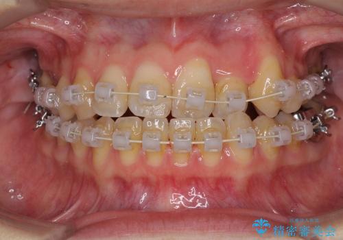 結婚式までに前歯を治したい　上顎骨の拡大を併用した抜歯矯正の治療中