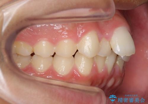 10代男性　出っ歯　歯を抜かない矯正の治療前