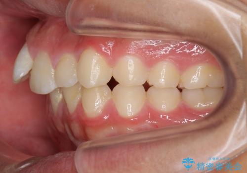 10代男性　出っ歯　歯を抜かない矯正の治療前