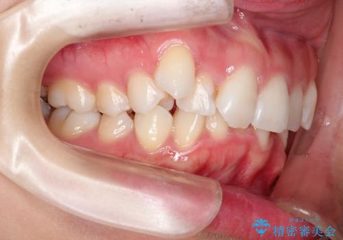 ハーフリンガルによる抜歯矯正の治療前