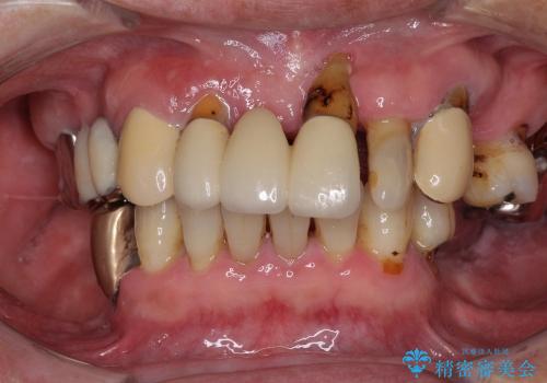 インプラントと入れ歯を用いた歯周病治療の治療前