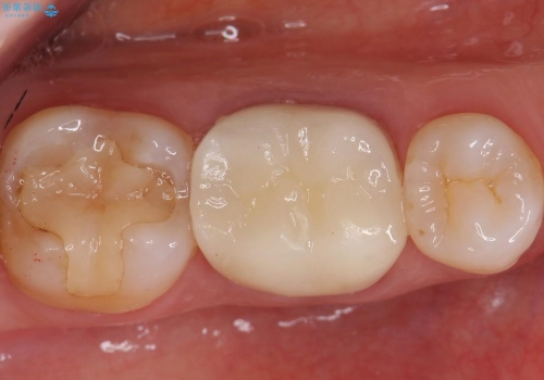 金属が露出してしまった歯の審美的補綴処置の治療後