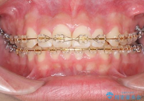 10代男性　出っ歯　歯を抜かない矯正の治療中