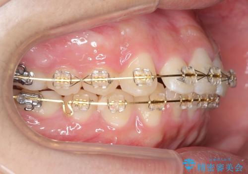 10代男性　出っ歯　歯を抜かない矯正の治療中