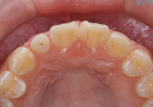 矮小歯　前歯の小さな歯を自然な形にの治療前