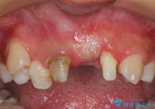 30代女性　ミゼラブルな前歯の陥没を再生する②結合組織の追加移植の治療後