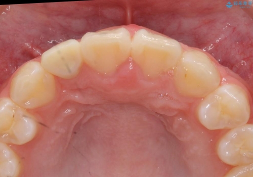 矮小歯　前歯の小さな歯を自然な形にの治療中