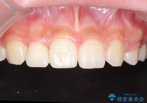 矮小歯　前歯の小さな歯を自然な形にの治療中