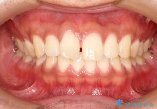30代男性　前歯のすきまを部分矯正で治したいの症例 治療前