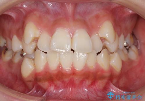 八重歯　神経のない奥の歯を抜歯の治療前