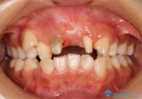 30代女性　ミゼラブルな前歯の陥没を再生する③完成への治療中