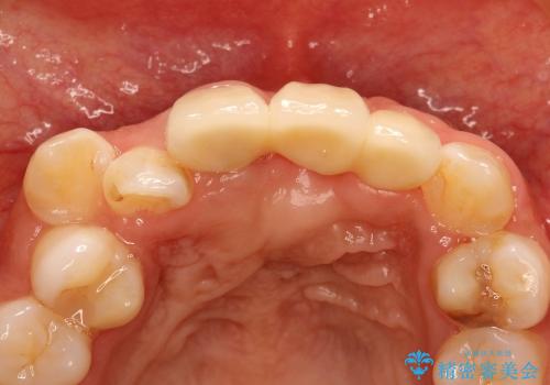 30代女性　ミゼラブルな前歯の陥没を再生する③完成への治療後