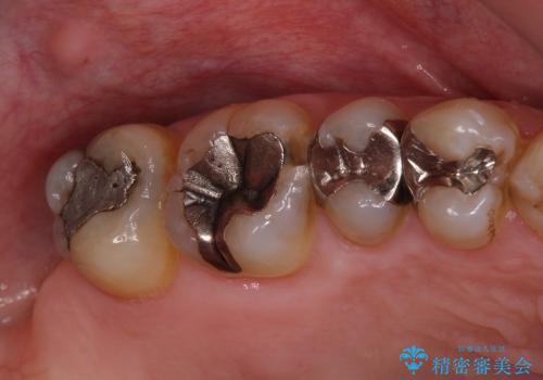 セラミックとゴールドを用いた奥歯のむし歯治療の治療前