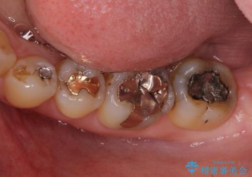 セラミックとゴールドを用いた奥歯のむし歯治療の治療前