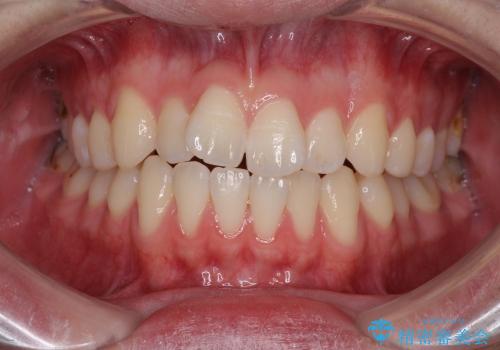 インビザラインによる非抜歯矯正　半年で前歯のがたがたを解消の治療前