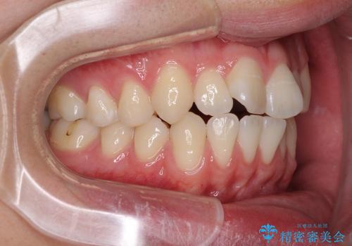 インビザラインによる非抜歯矯正　半年で前歯のがたがたを解消の治療前