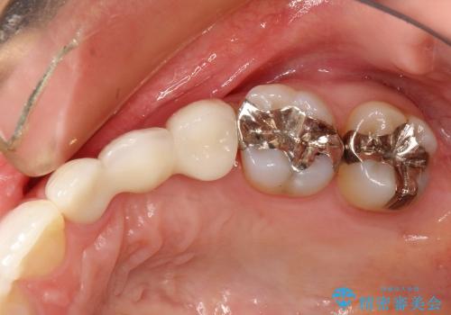 30代女性　前歯部審美ブリッジ修復の治療後