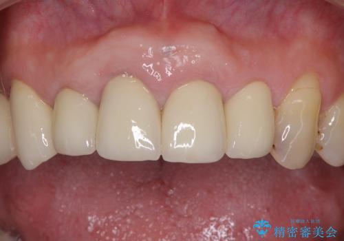 歯の根元が露出してきた　オールセラミックの再補綴での改善の治療後