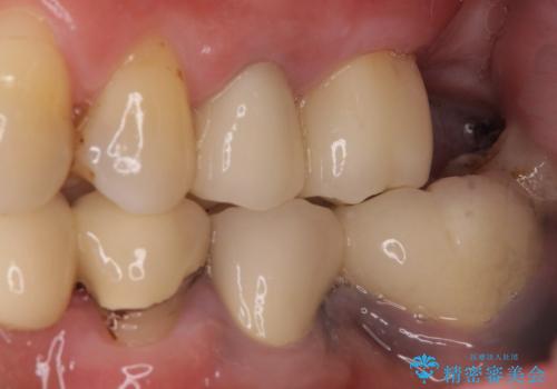 歯の根元が露出してきた　オールセラミックの再補綴での改善の治療後
