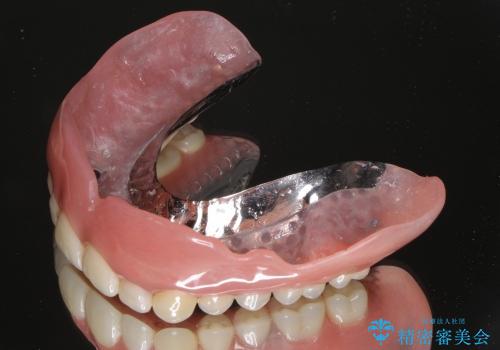 インプラントと入れ歯を用いた歯周病治療の治療中