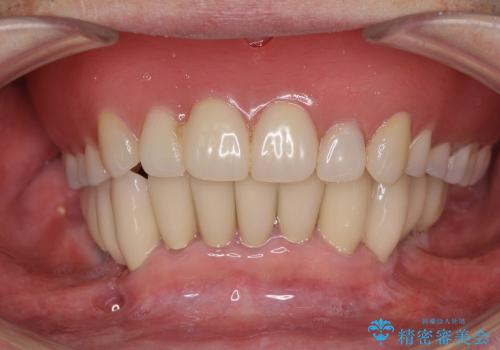 インプラントと入れ歯を用いた歯周病治療の治療後