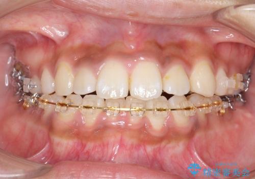 [大きい正中のずれ] 裏側矯正で前歯のねじれ・顎のゆがみを改善の治療中