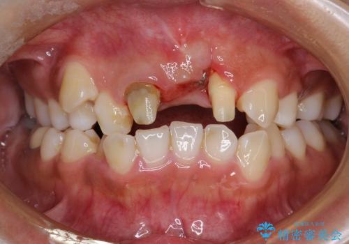 30代女性　ミゼラブルな前歯の陥没を再生する②結合組織の追加移植の治療前