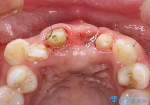 30代女性　ミゼラブルな前歯の陥没を再生する②結合組織の追加移植の治療前