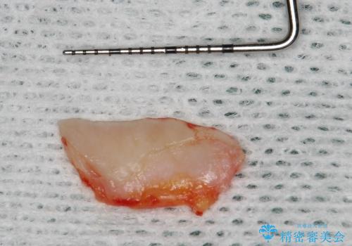 30代女性　ミゼラブルな前歯の陥没を再生する②結合組織の追加移植の治療中