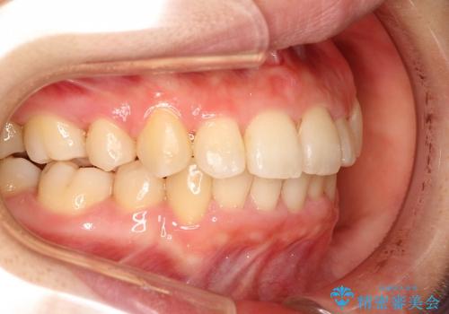 20代女性　ガタガタの歯を矯正してきれいに　表のワイヤー矯正の治療後