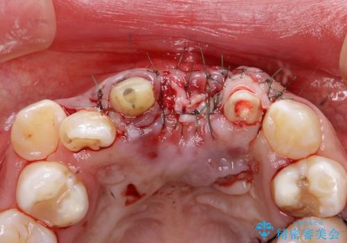 30代女性　ミゼラブルな前歯の陥没を再生する②結合組織の追加移植の治療中